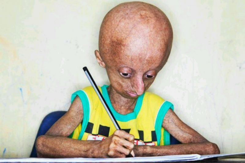 Nihal, face of Progeria in India dies at 15