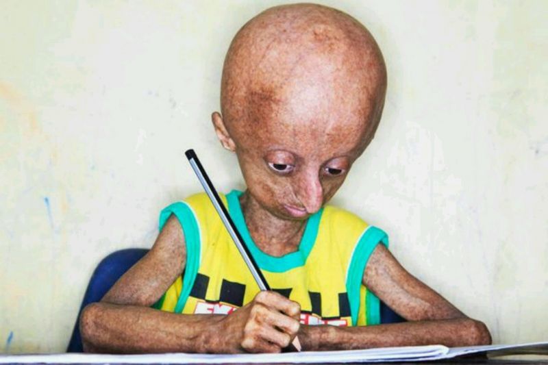 Nihal, face of progeria in India dies at 15